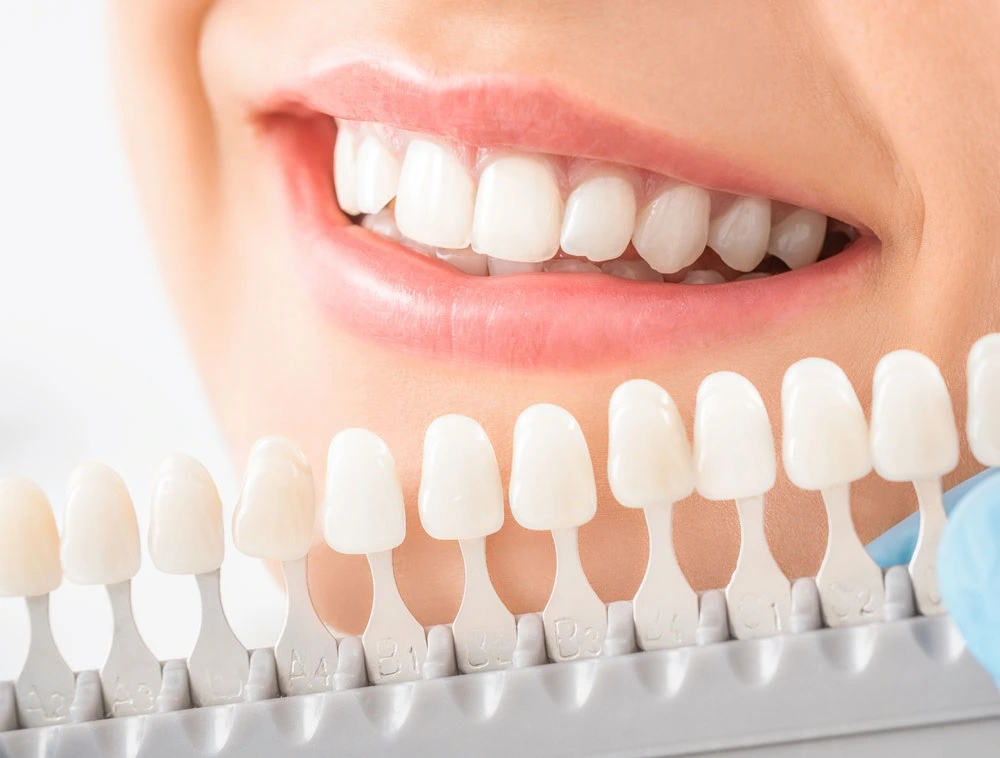 best veneers houston